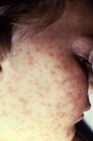 Figure 3. Spotted fever rash. Photo courtesy of the Centers for Disease Control and Prevention