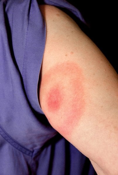 Figure 5. Bulls-eye rash caused by Lyme disease and STARI Photo courtesy of the Centers for Disease Control and Prevention