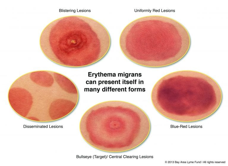 Um Al Rash Rash Map Ticks & Tick-borne Illnesses in Alabama - Alabama Cooperative Extension ...