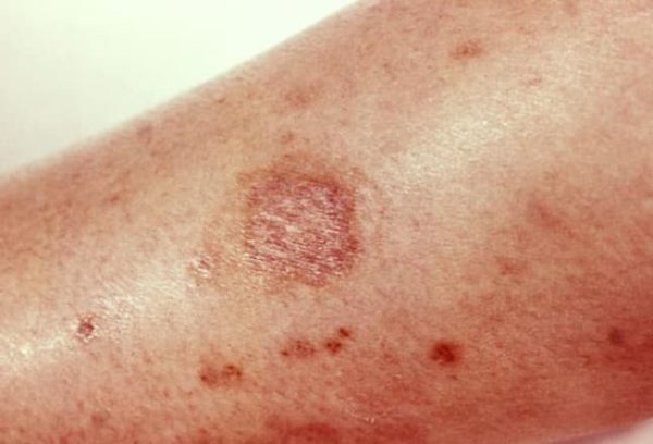 Figure 5. Brown recluse bite. (Photo credit: Centers for Disease Control and Prevention).