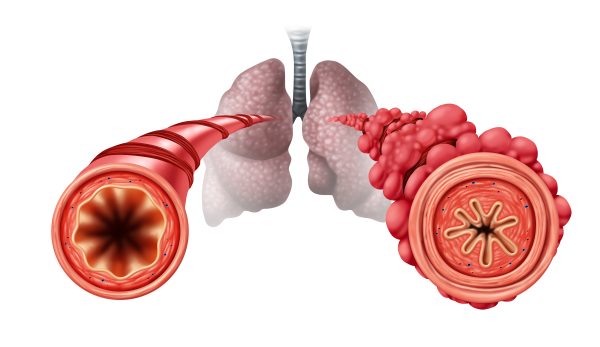 Vaping can cause obstructed bronchial tubes and popcorn lung.