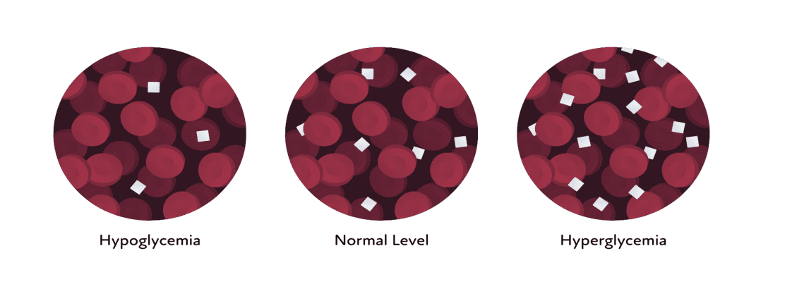 A diagram showing hypoglycemia, normal levels, and hyperglycemia.