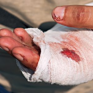 Figure 7. Thirty-five percent of injuries occur to the left hand due to operators removing the hand to hold limbs or drag brush. Always keep two hands on the saw unless the chain brake has been engaged.