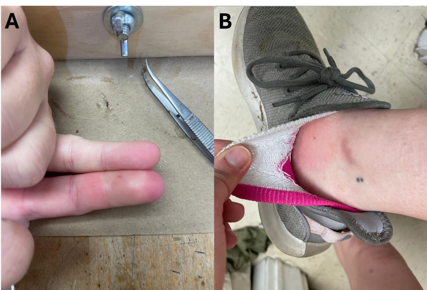 Figure 5. Examples of local reactions after a honey bee sting. When a local reaction occurs, the swelling is largely restricted to the body part that got stung, such as a finger (A) or the ankle (B).